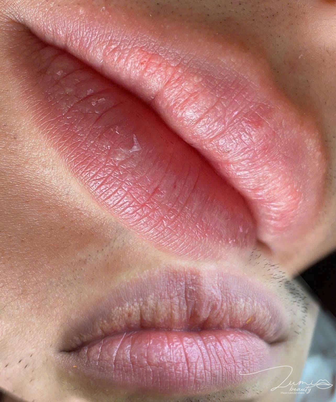 Môi thâm đậm – cải thiện sau 3 ngày