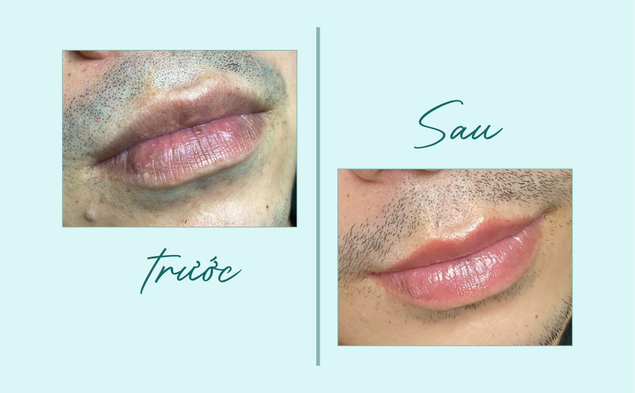 Khử thâm môi nam trước và sau - kết quả tự nhiên, không đỏ như son