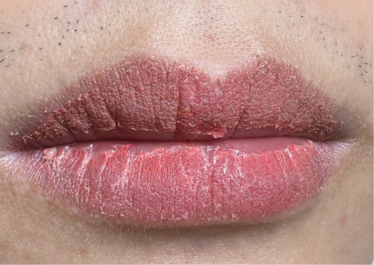 Môi nam trong giai đoạn bong nhẹ - không đau, không sưng