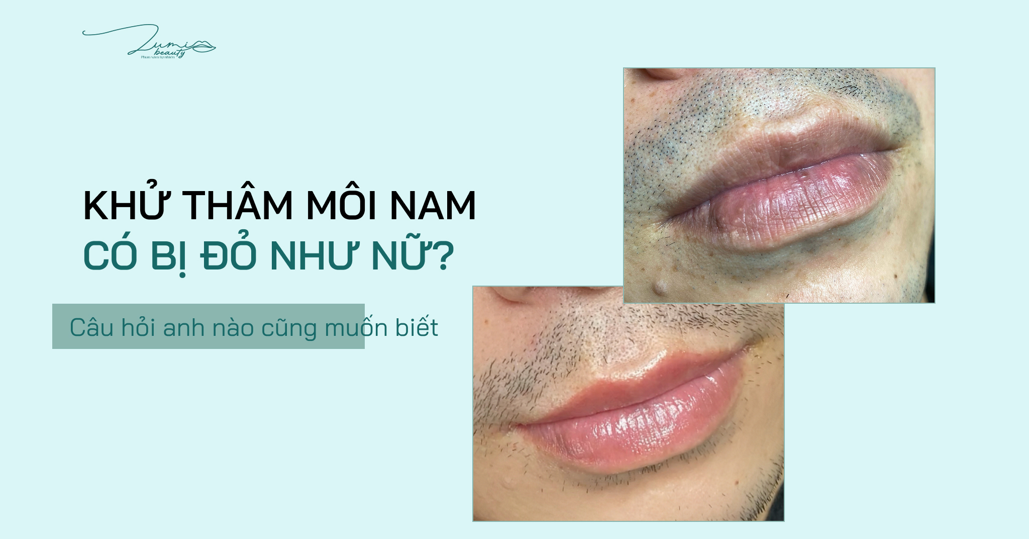 Khử thâm môi nam có bị đỏ như nữ không?