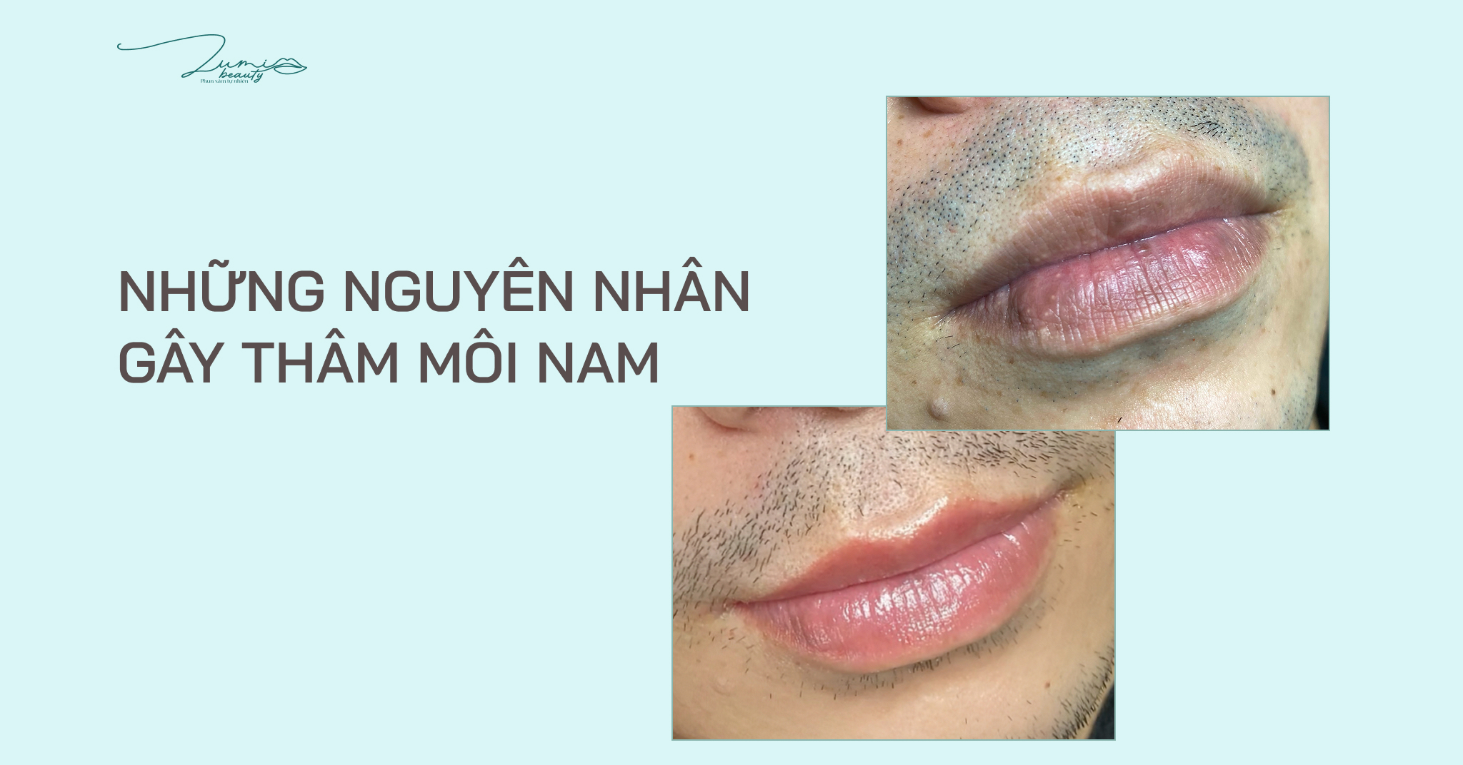 Những nguyên nhân khiến nam giới bị thâm môi